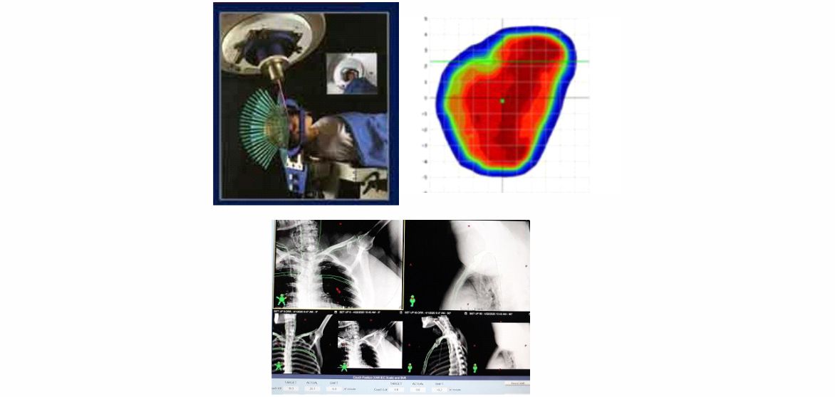 Εξελίξεις στην Ιατρική Απεικόνιση στην Ακτινοθεραπεία